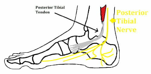 What Is Posterior Tibial Tendonitis